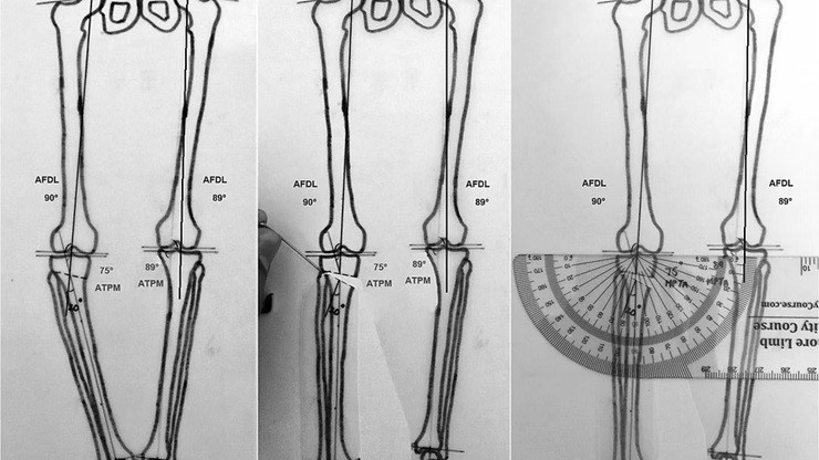Planejamento de osteotomia do joelho para correção do alinhamento do membro inferior