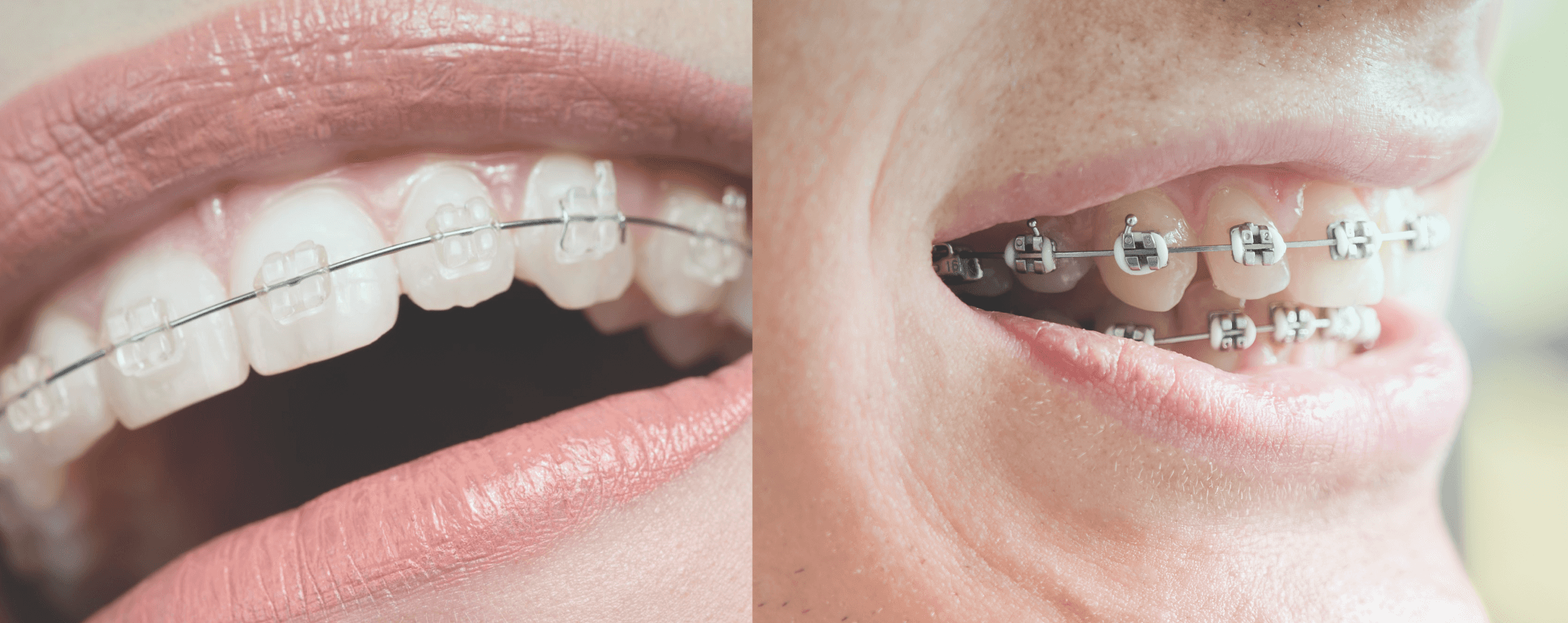 Fixed braces