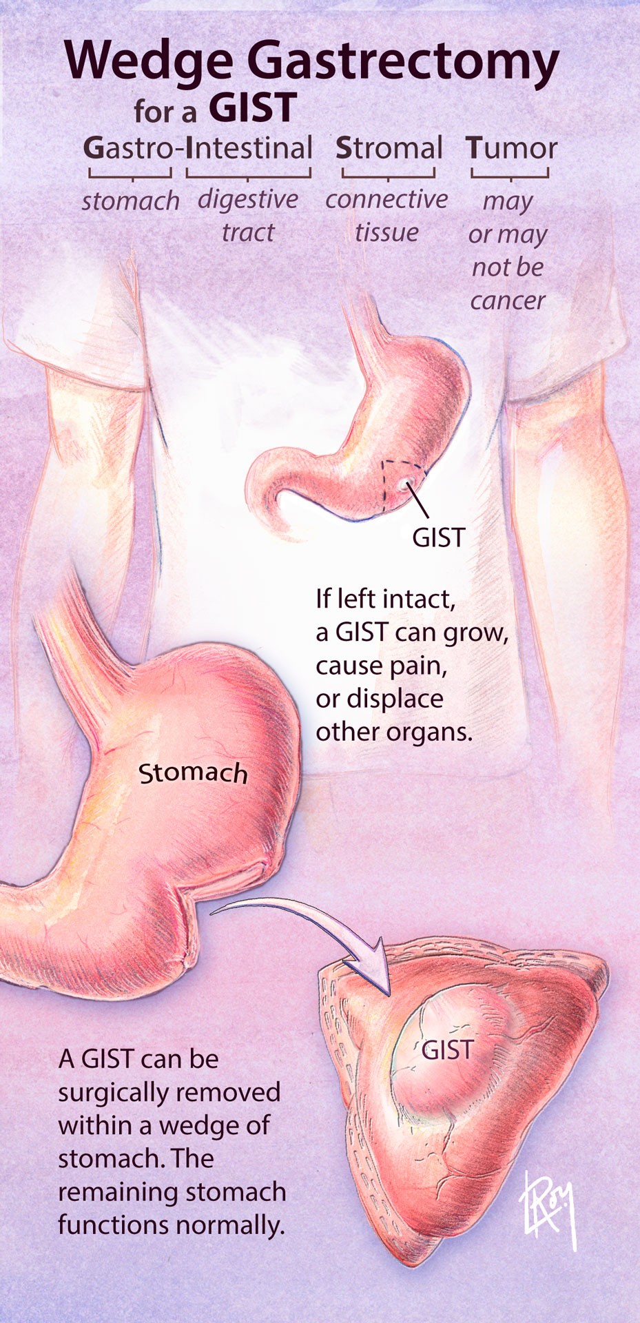 Wedge Gastrectomy Patient Overview Brochure