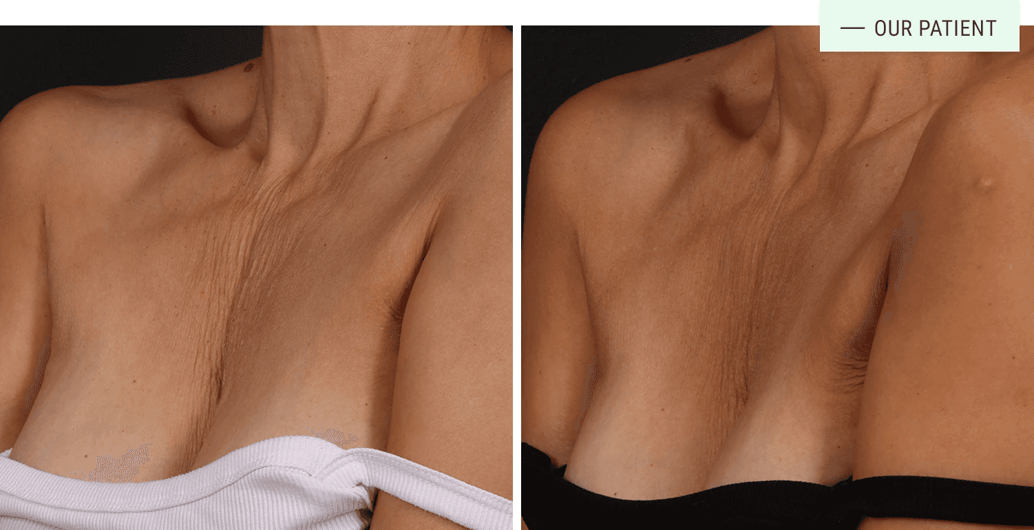 Safety Considerations for HA Filler and PLLA