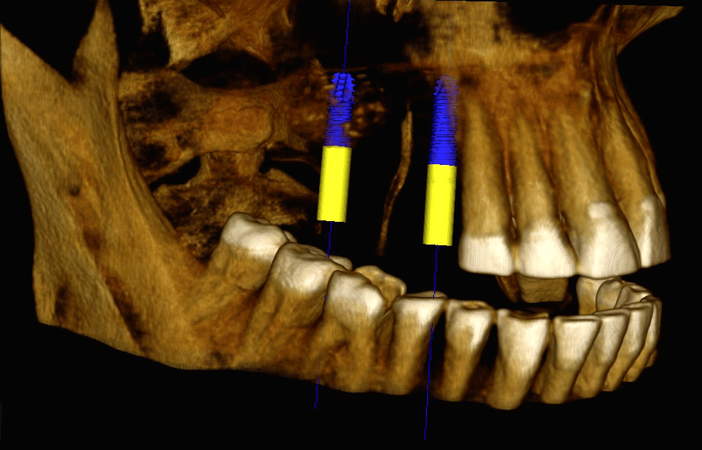CBCT snímka plánovania zavedenia dvoch implantátov