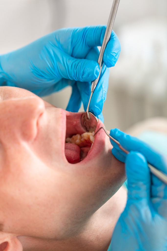 Pericoronarite: O que é e como tratar | Blog | MALO CLINIC