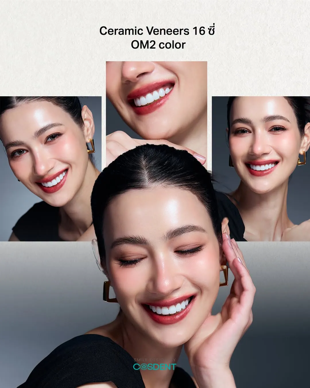 Ceramic veneers on 16 teeth in shade OM2 — smile design case at COSDENT Bangkok