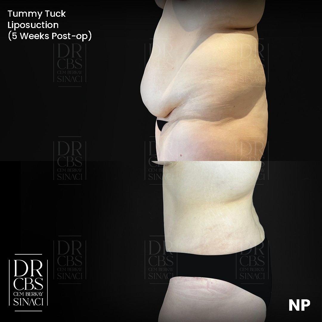 5 weeks before after photo of liposuction tummy tuck side view