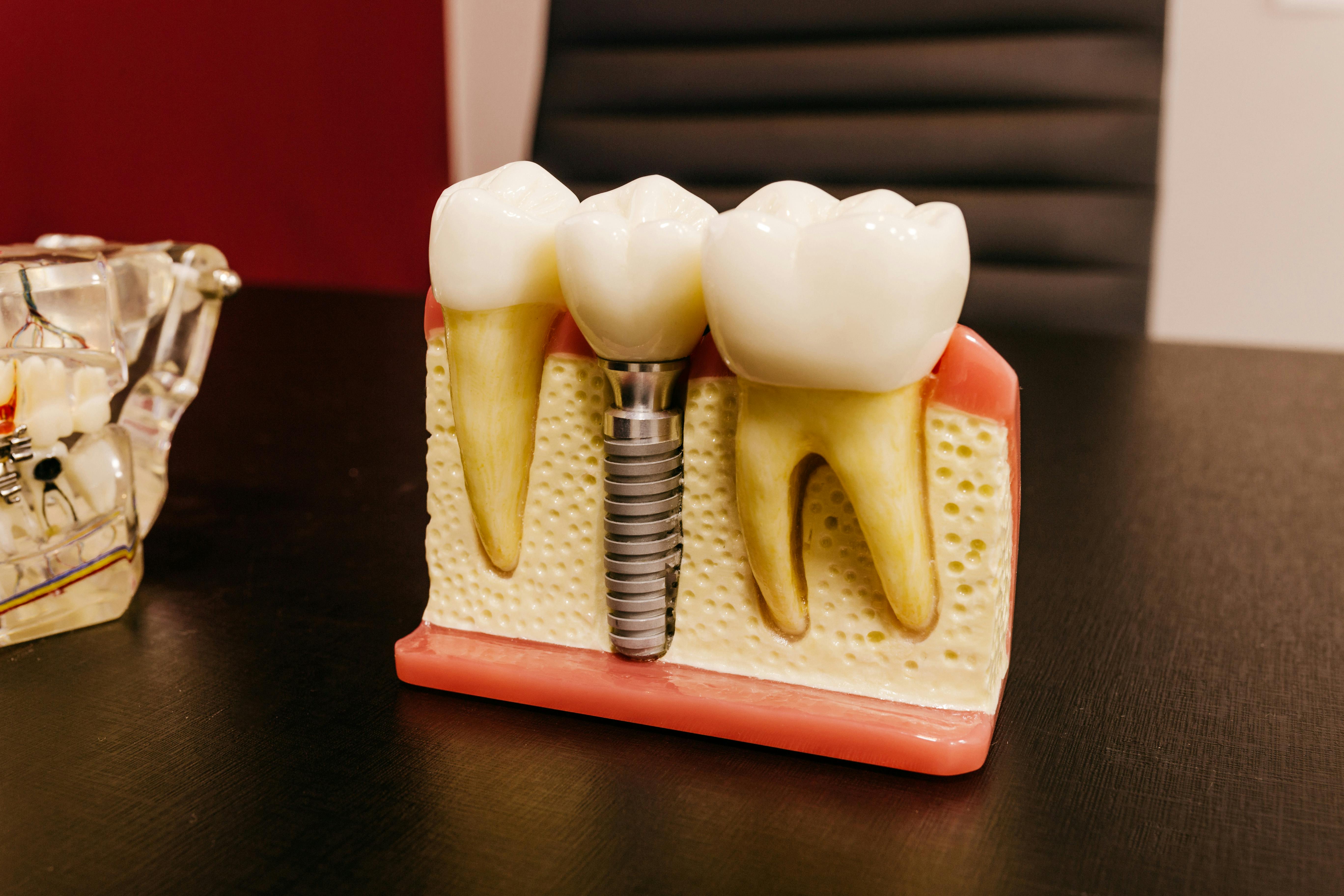 dental clinique doctor showing a dental implant