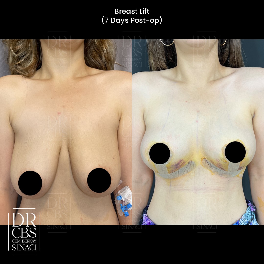 breast lift before after 7 days front view