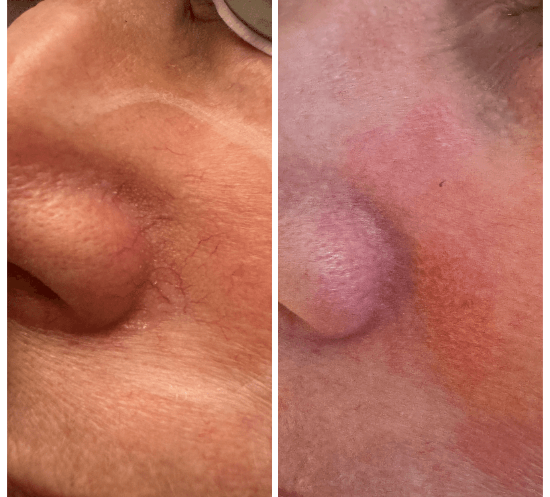 Close-up of face, showing skin condition before and after treatment