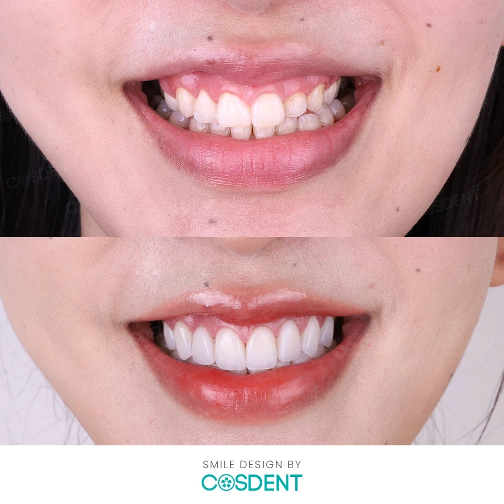 รีวิวออกแบบรอยยิ้ม ที่ cosdent smile design