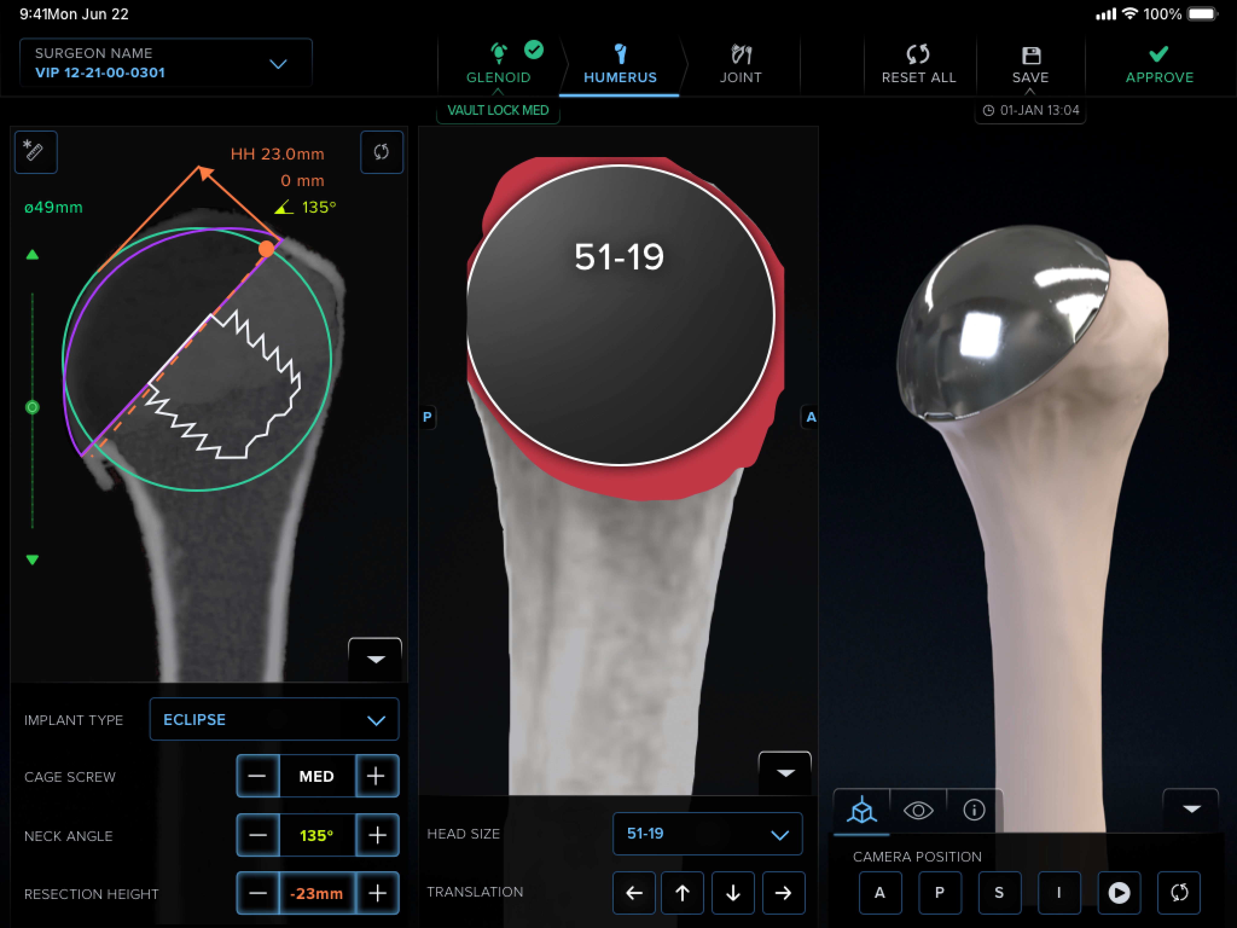 The VR-based planning tool in use, headset view or a surgeon using it to plan a case