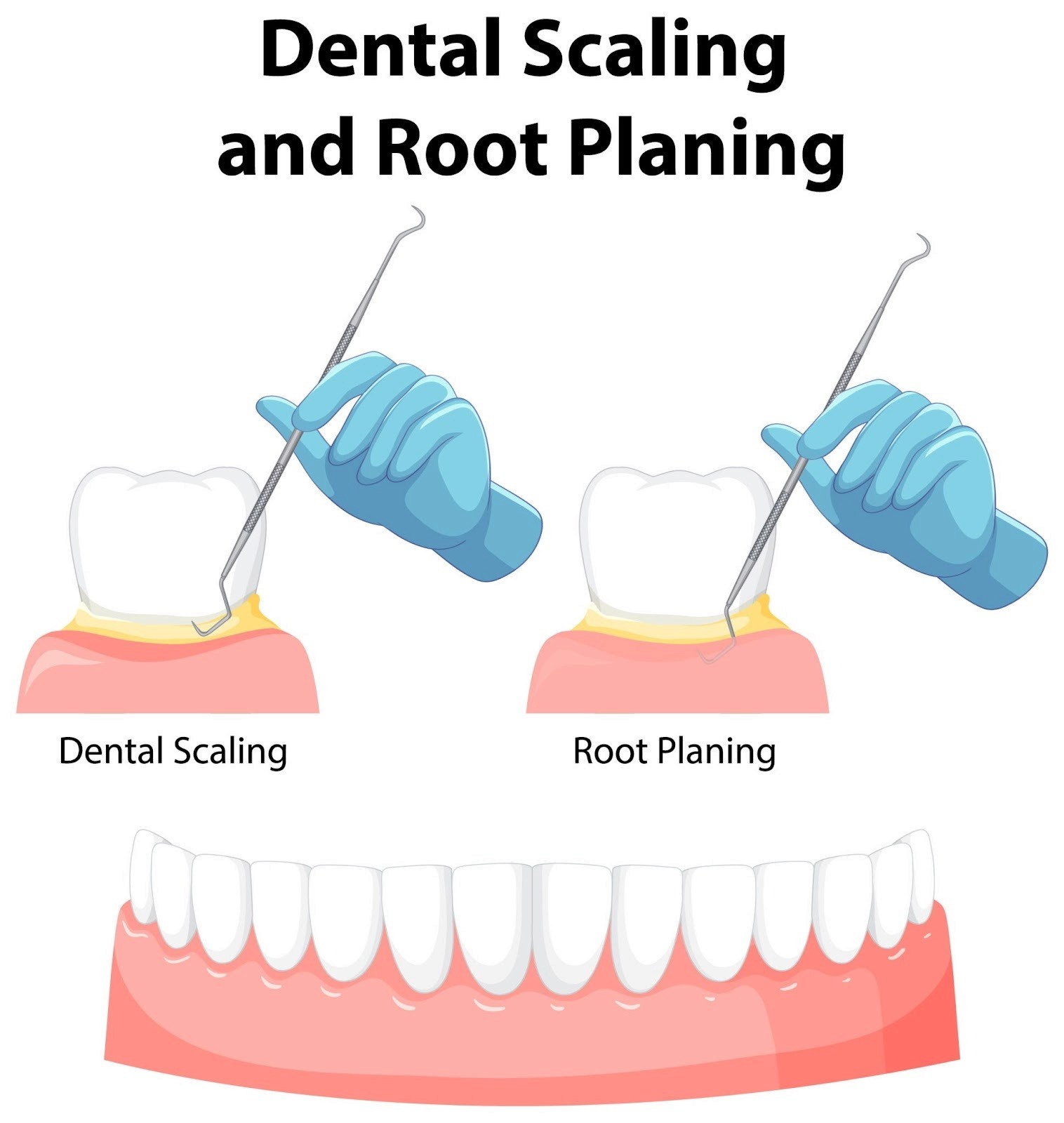 Image of scaling and root planing diagram