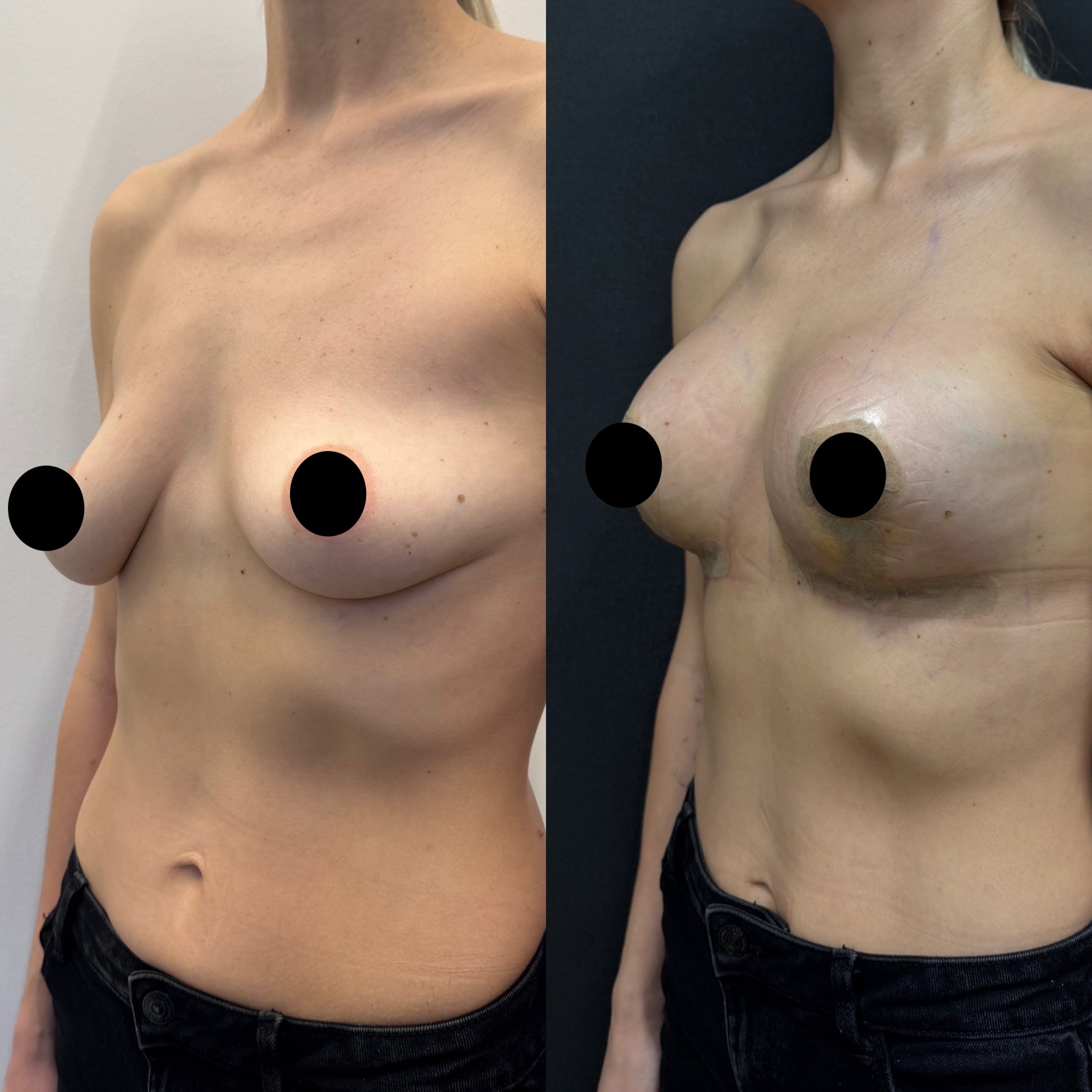 breast lift with implant before after photo 5 days post surgery oblique view