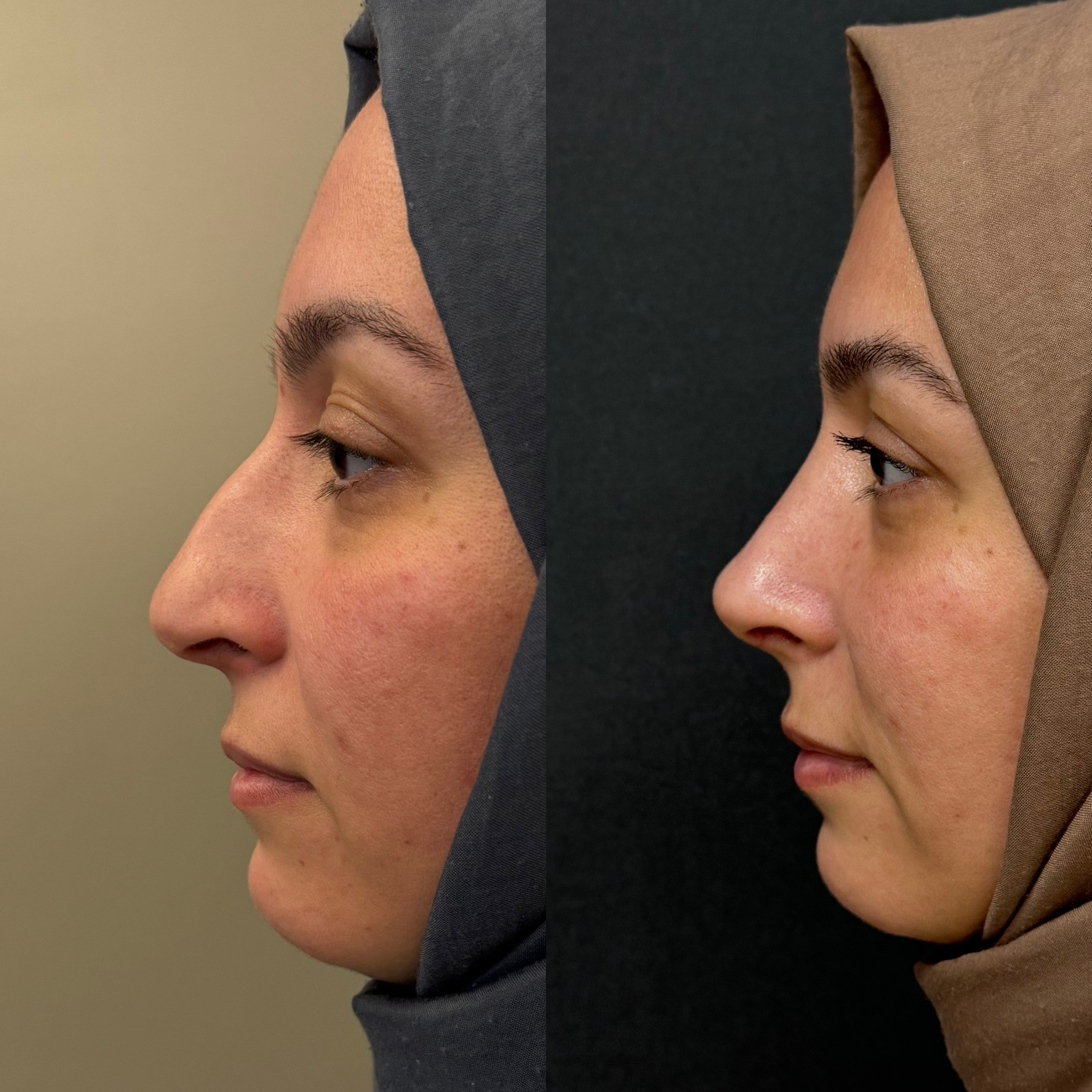 1 month rhinoplasty patient before after side view