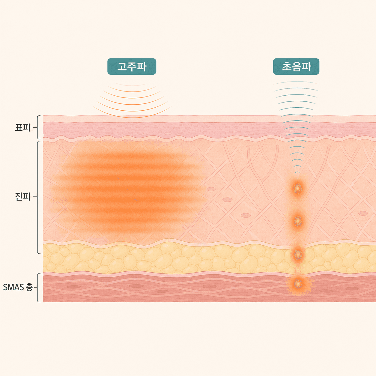 깊은 SMAS 층에 점으로 닿는 초음파와 넓게 데우는 고주파