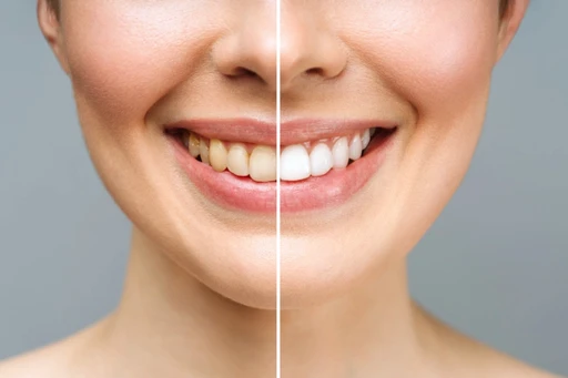 Comparaison des dents Blanchiment