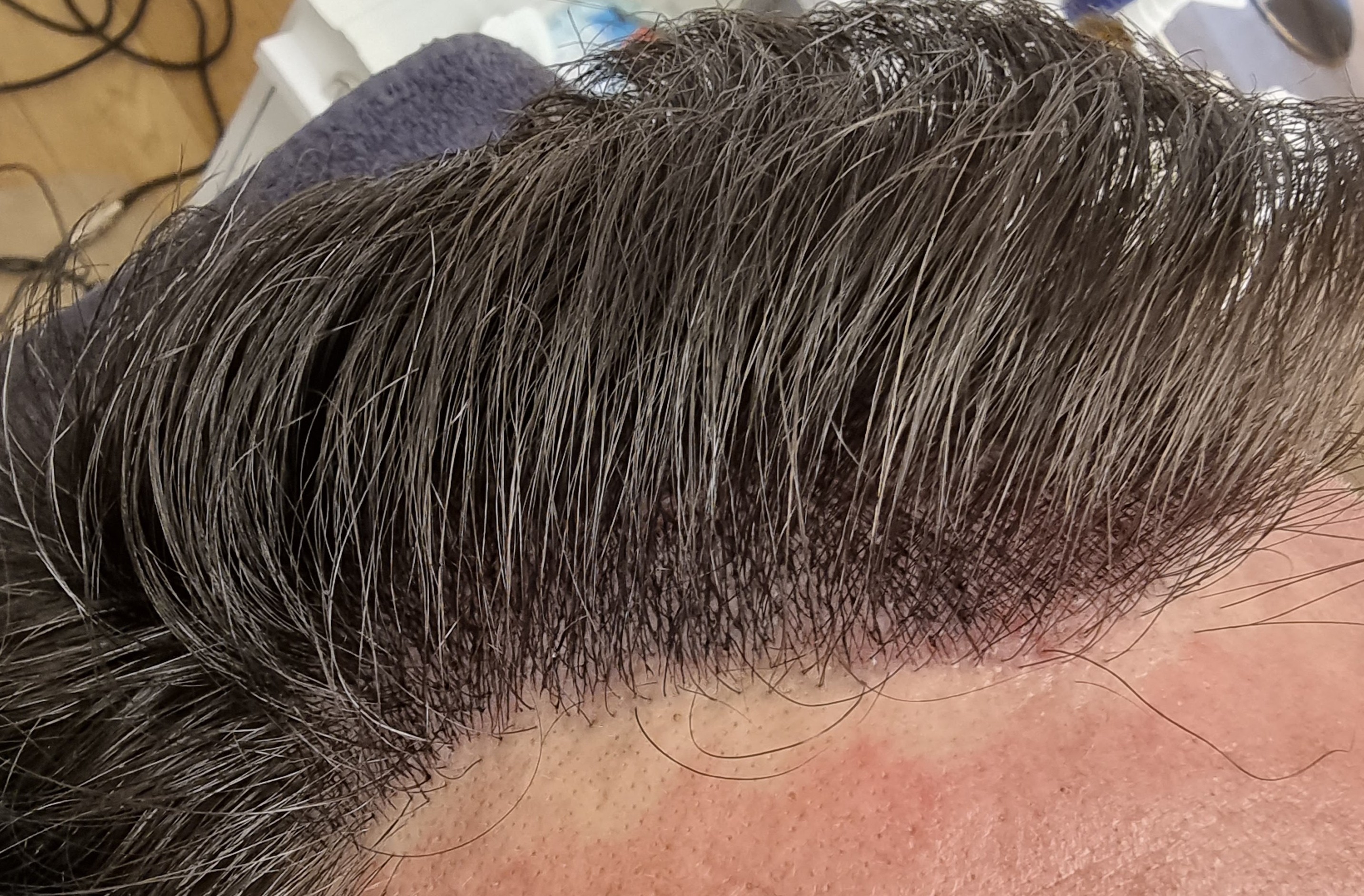 Micro haar pigmentatie Alluris
