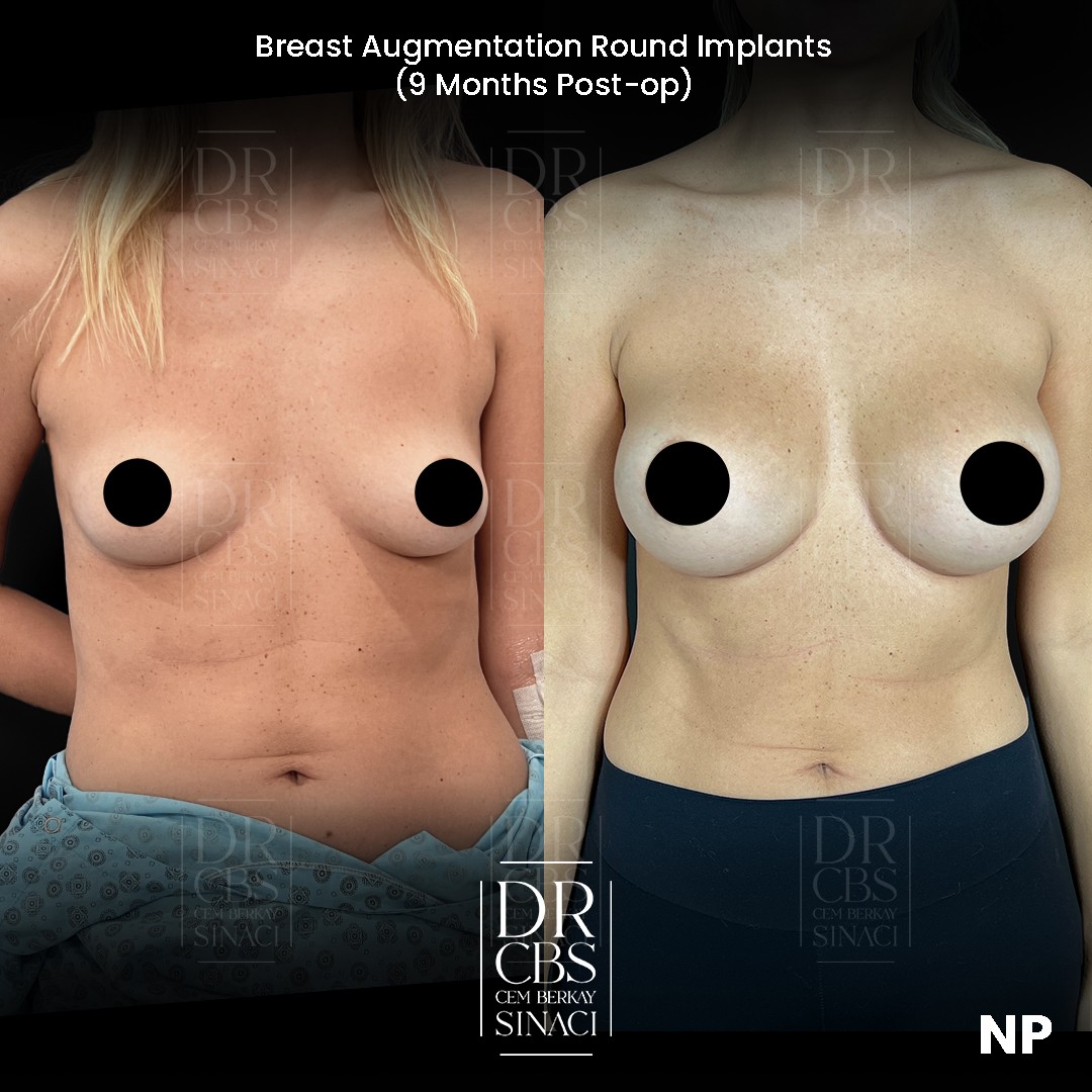 breast implant before after result front view