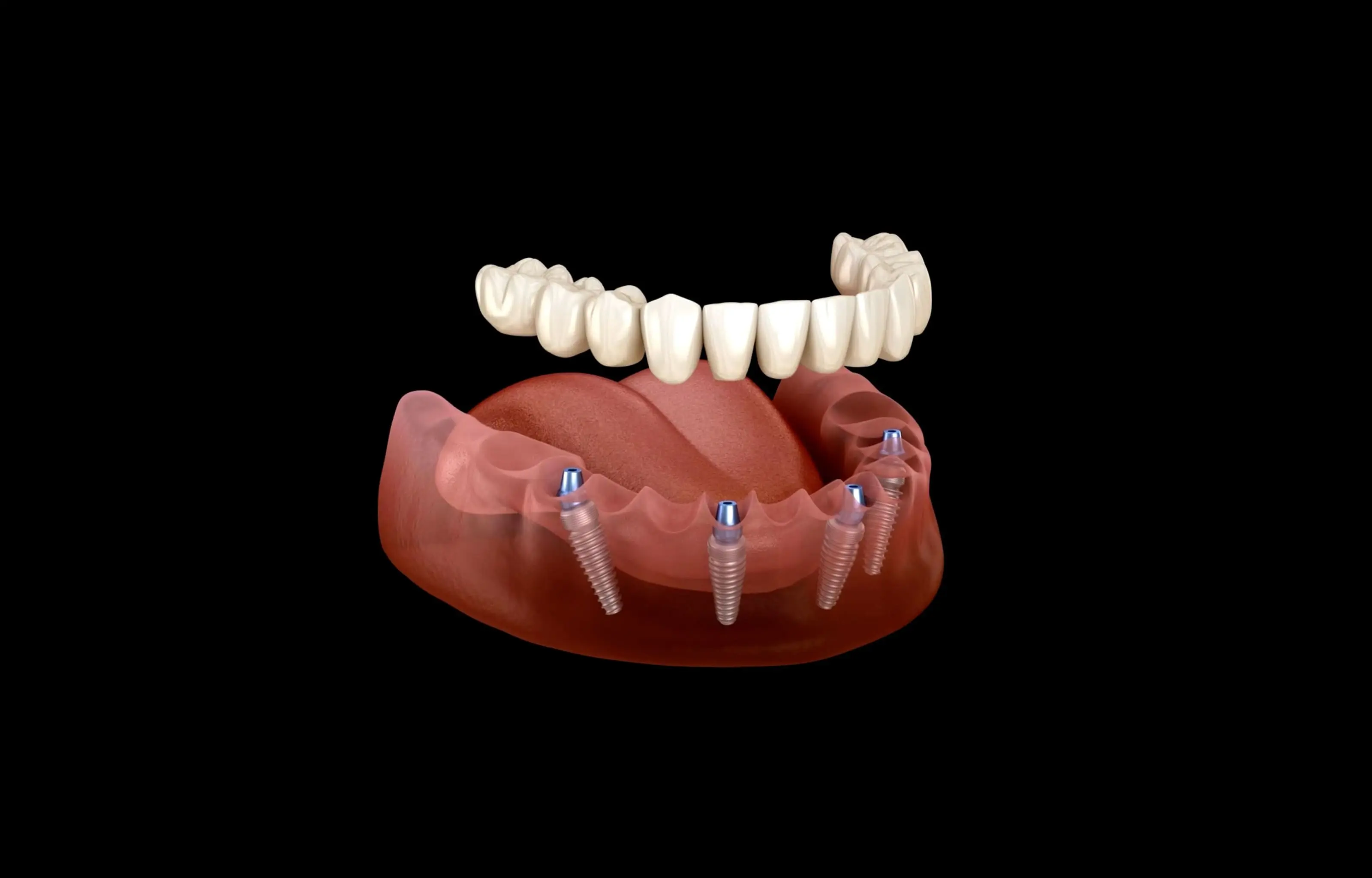 Dental Implants in Bergen County