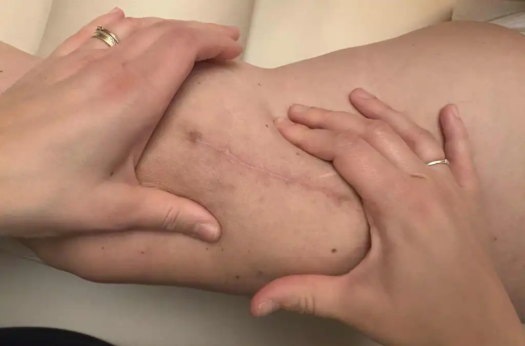 Soins de kinésithérapie pour les traitements des cicatrices pratiquée par Marine Evrard.