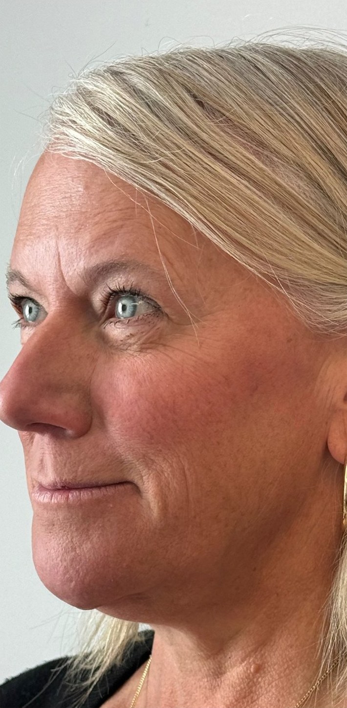 Before: a woman with light hair in three-quarter view.