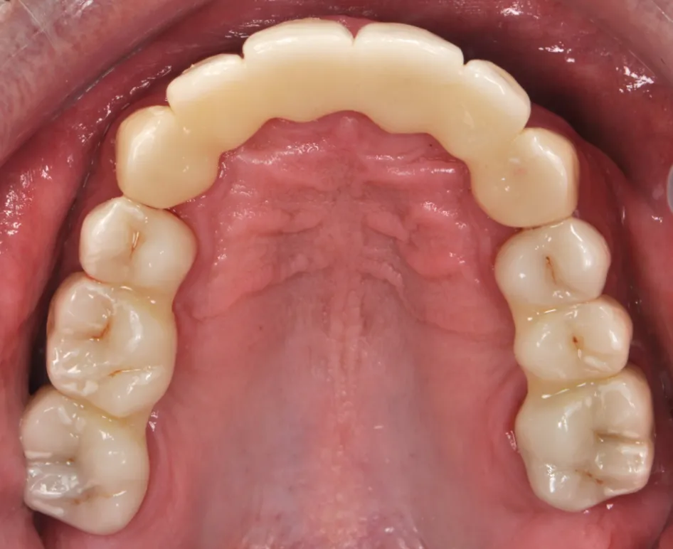 After ortho treatment