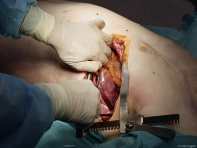 Anterolateral emergency thoracotomy