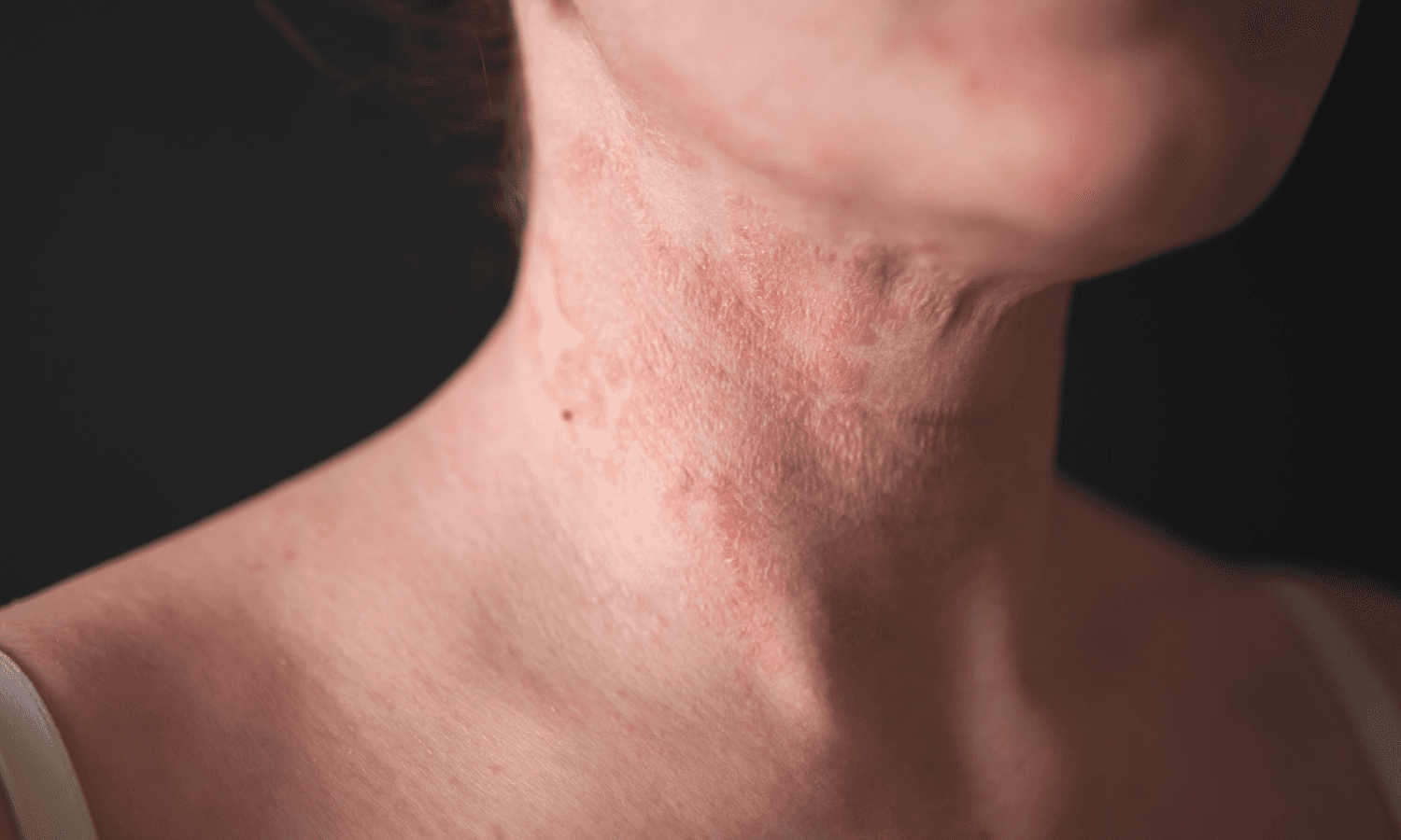 Neck with eczema