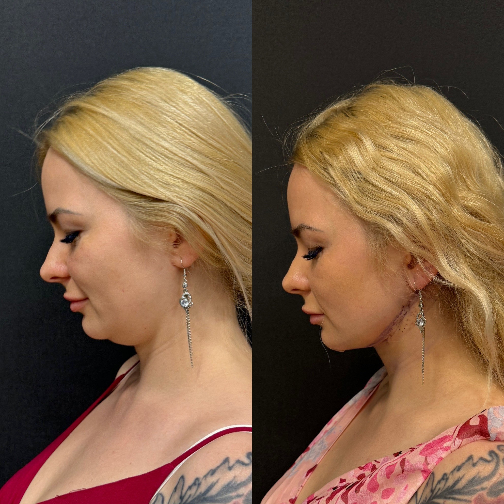 double chin liposuction before after 1 day post-surgery side view