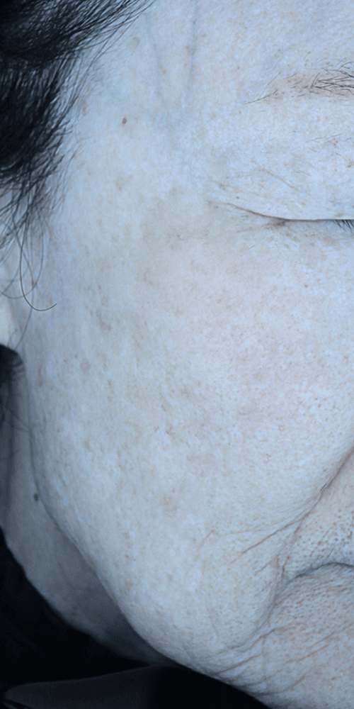 Pigmentation - After