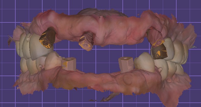 bone 의 상태를 고려하여 식립한 임플란트 패스