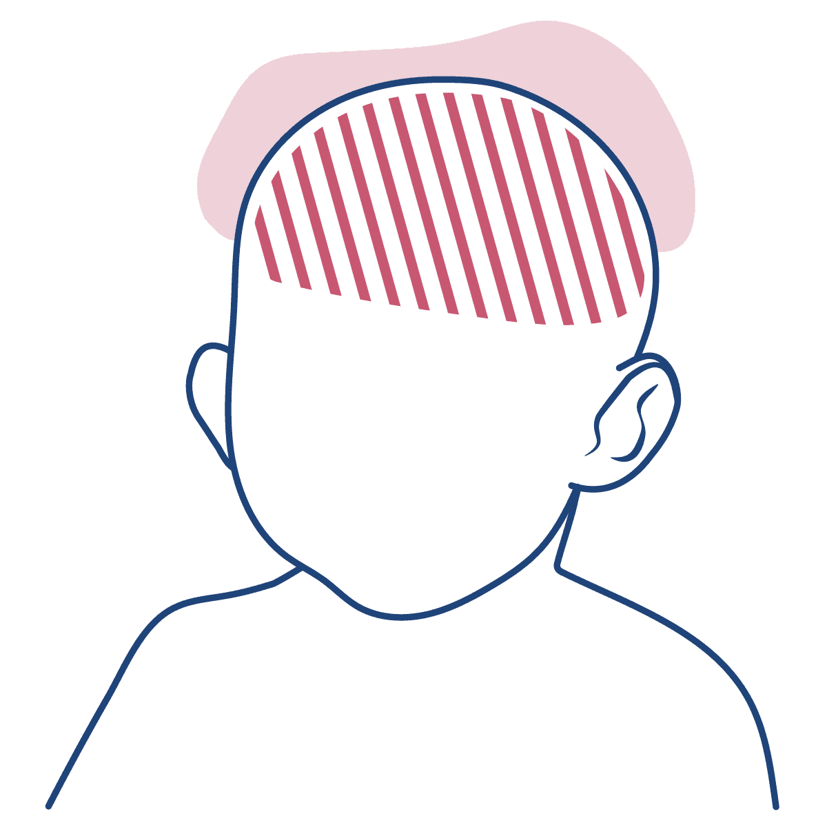 Ilustração em linhas azuis mostra uma criança, com uma mancha em rosa escuro rajada simbolizando a cranioestenose