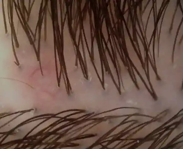 Calvice Feminina Couro Cabeludo