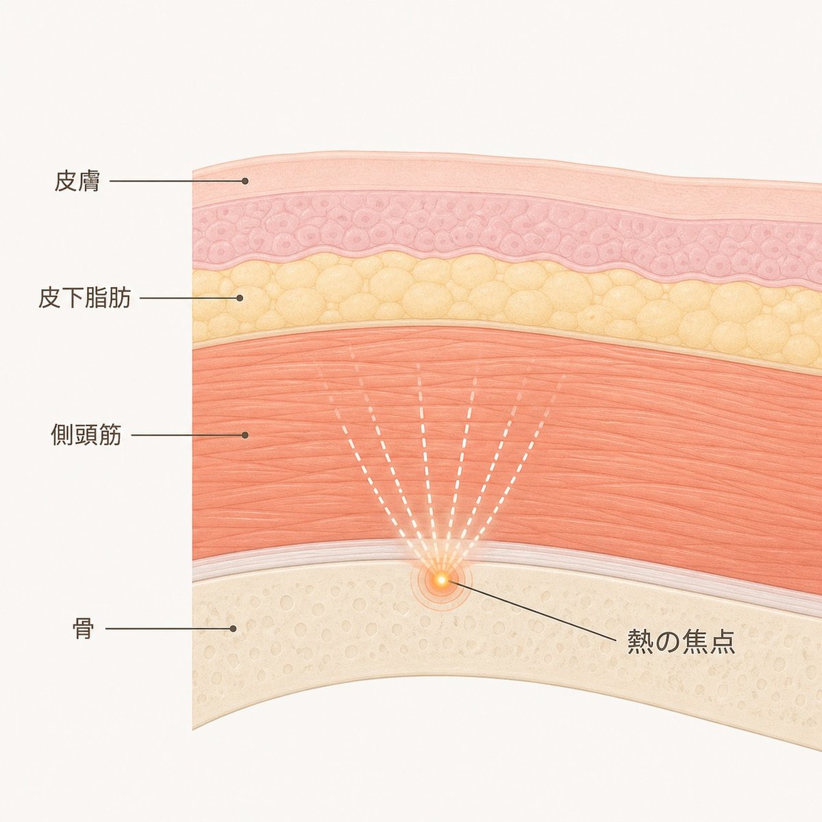 こめかみの断面図。皮膚・皮下脂肪・側頭筋・骨の位置と、超音波の熱が集まる深さを示している