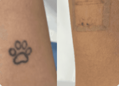 Imagem de antes e depois da remoção de tatuagem