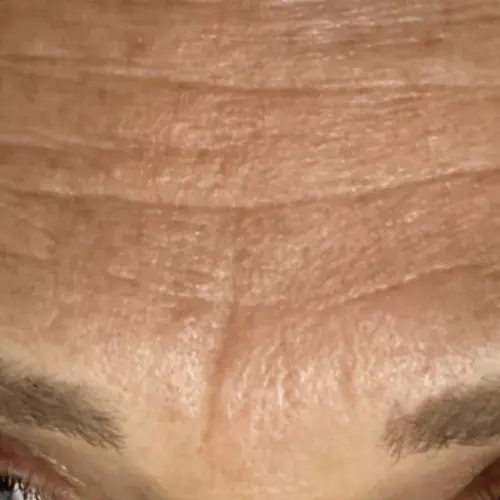Before HydraFacial MD at The Vancouver Aesthetician — visible fine lines, wrinkles, and dull dehydrated skin