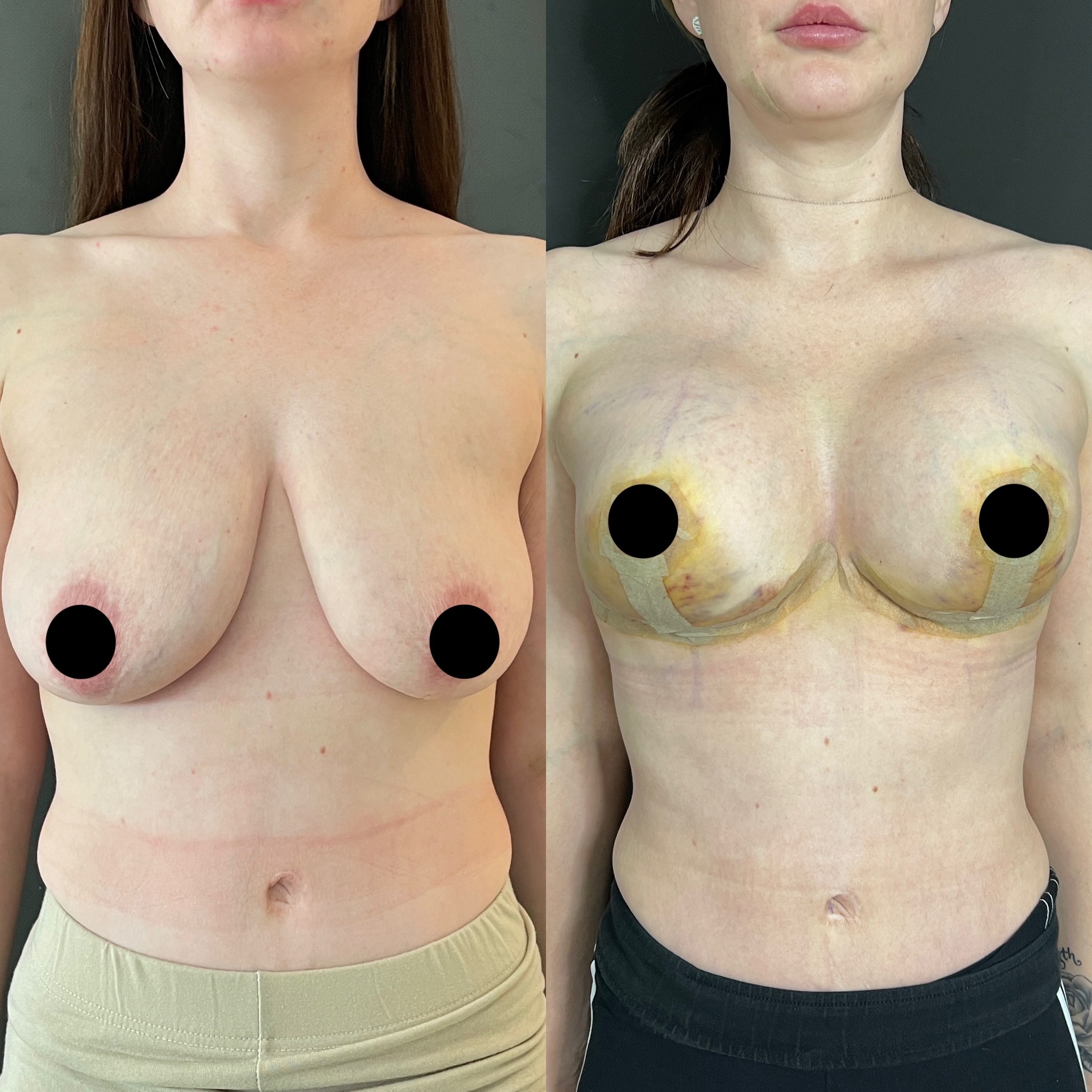 tuberous breast deformity before after 5 days result front view