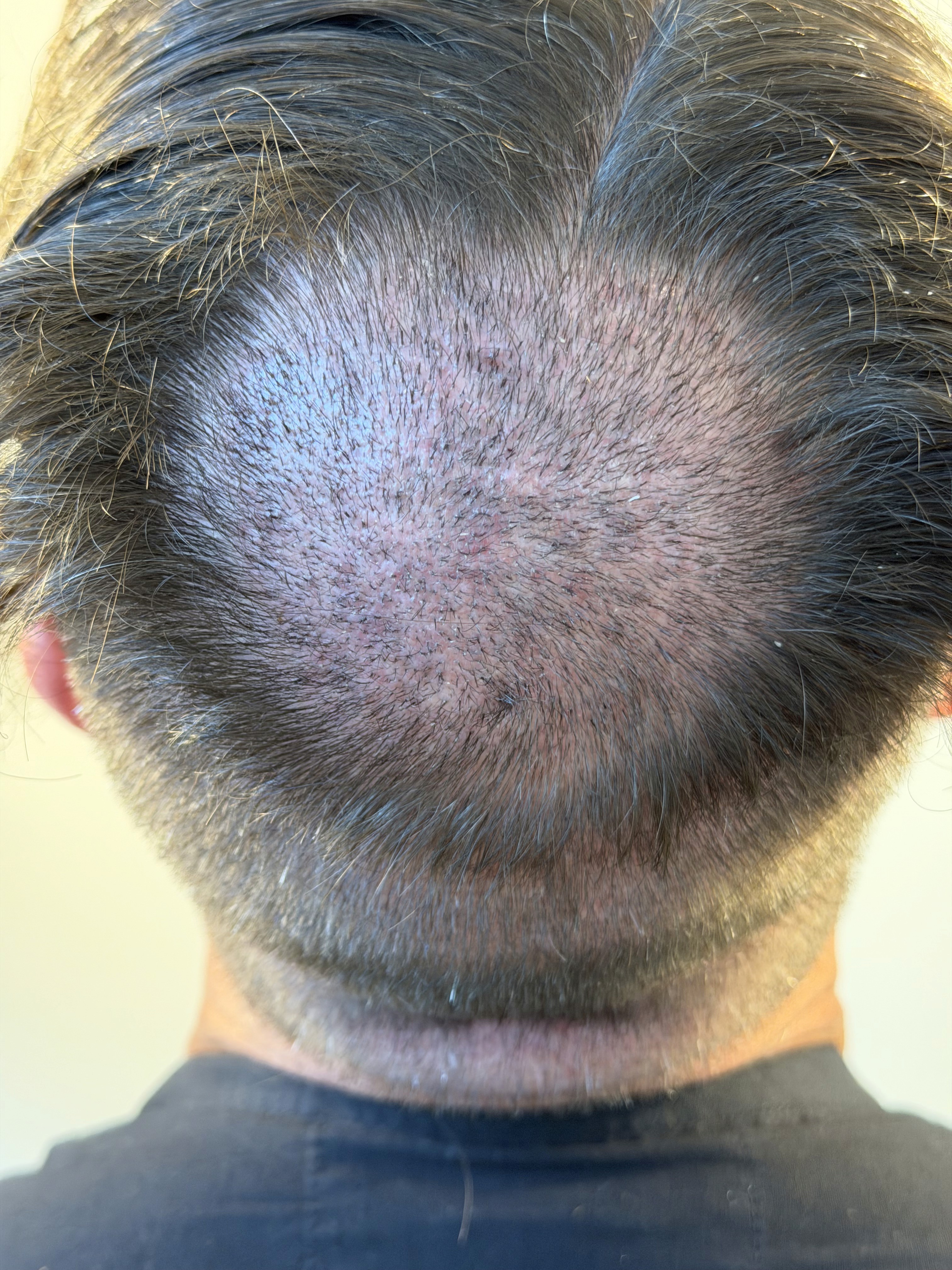 donor Recipient area during the early healing period after a hair transplant
