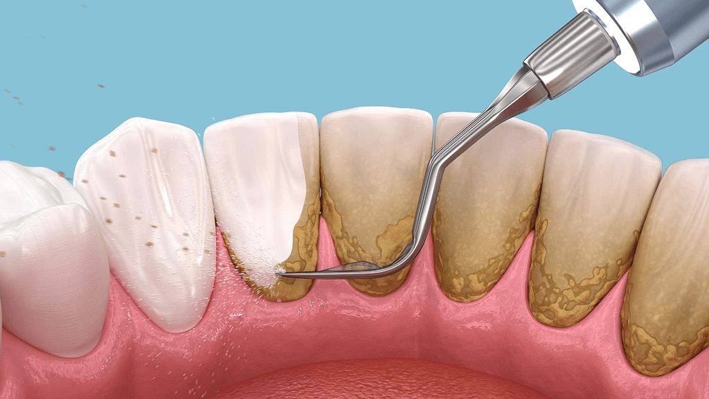 removing plaque and tartar