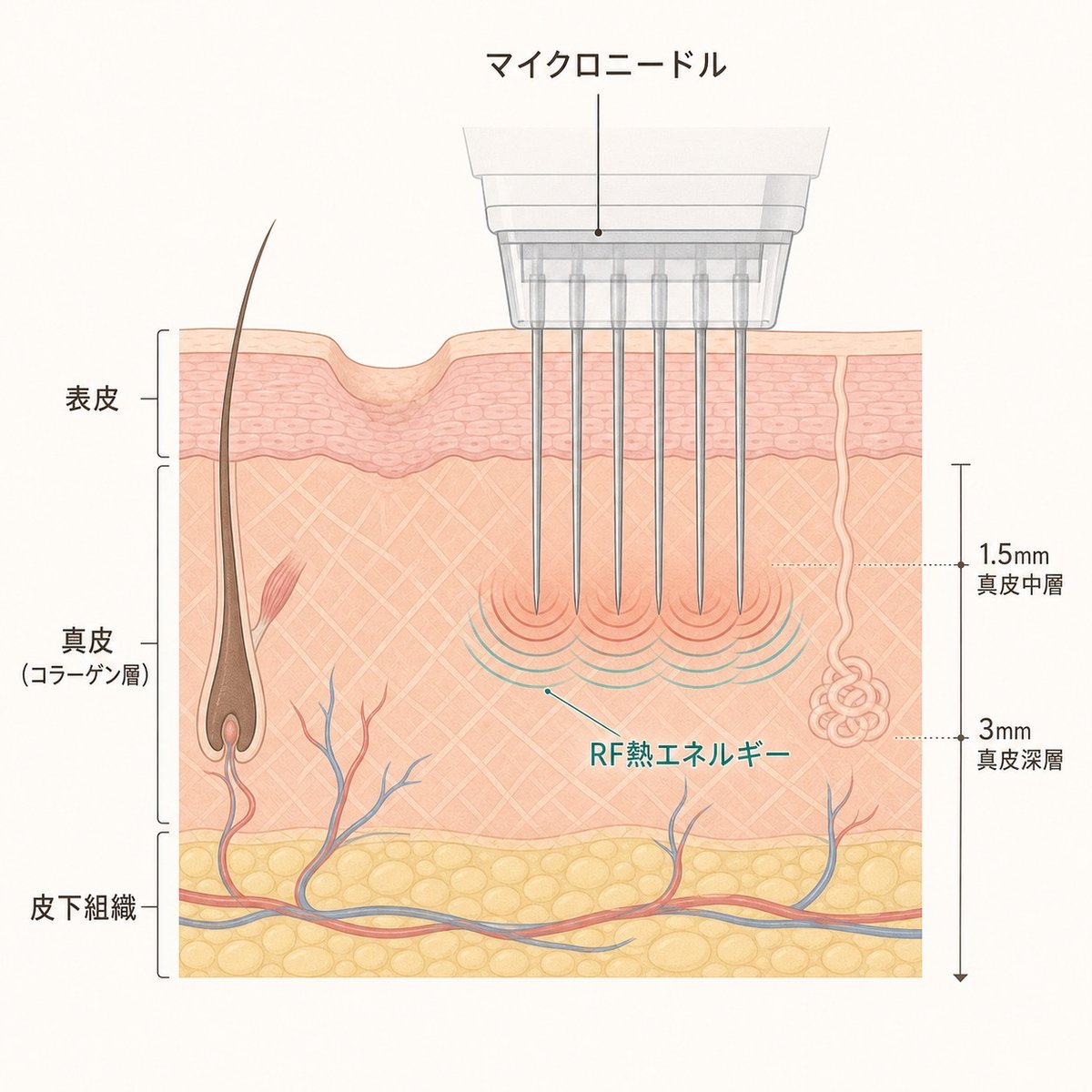 シークレットRFの針が真皮層にRFエネルギーを届けるメカニズムのイラスト