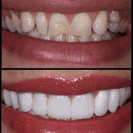 Dental veneers Dubai with before and after images demonstrating repaired chipped teeth and a smoother, more uniform smile.