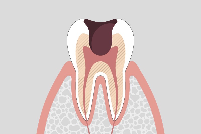むし歯の進行段階とその治療方法