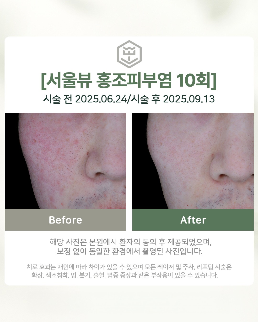 홍조피부염 10회