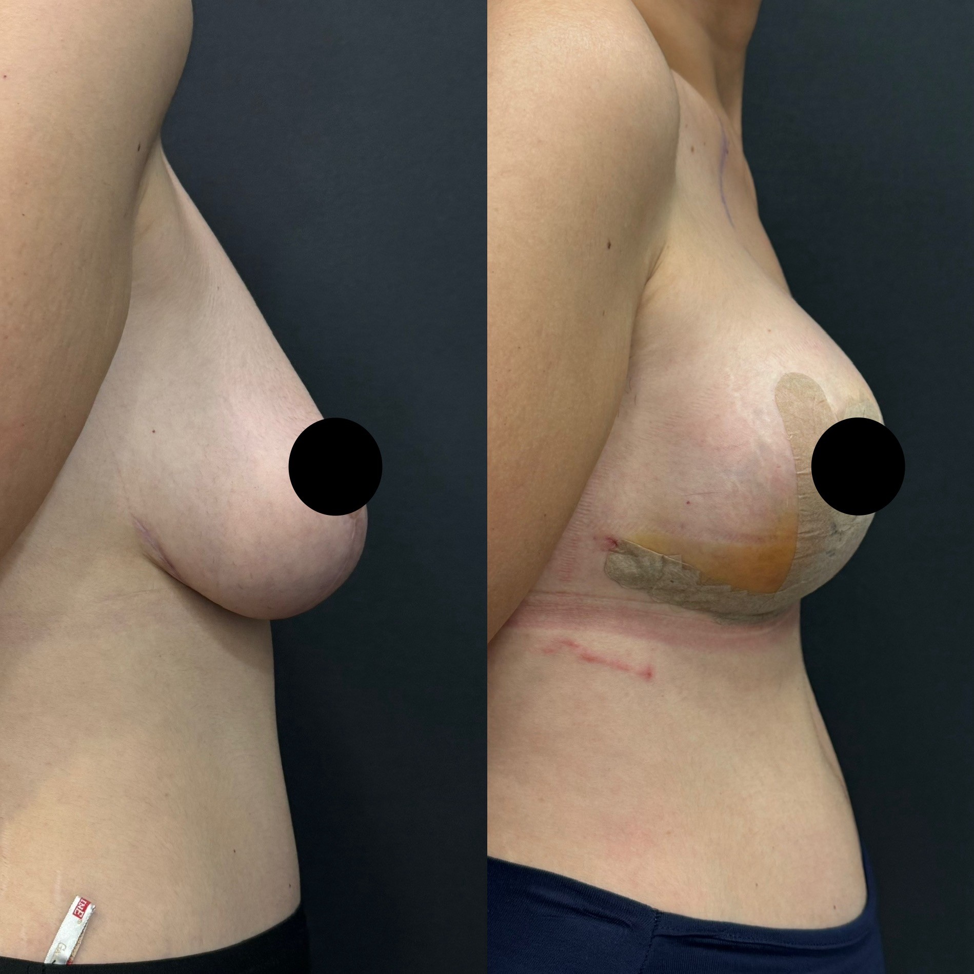 Revision breast lift with implant before after side view