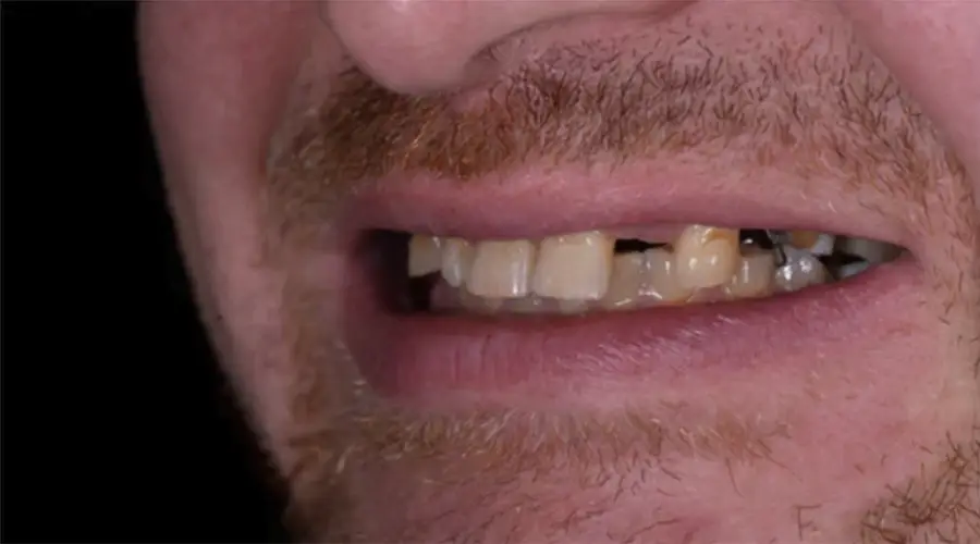 Patient smile prior to single tooth implant treatment showing a missing tooth and surrounding dental condition.