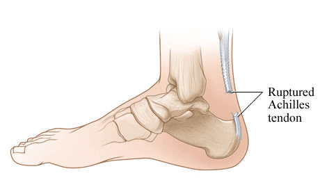 Image describes Achilles Tendon Rupture