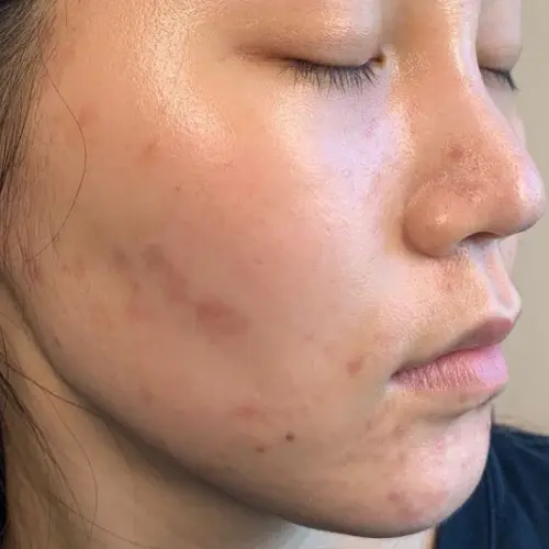 After acne treatment at The Vancouver Aesthetician — acne gone, picking scars healed and skin visibly glowing and fully restored