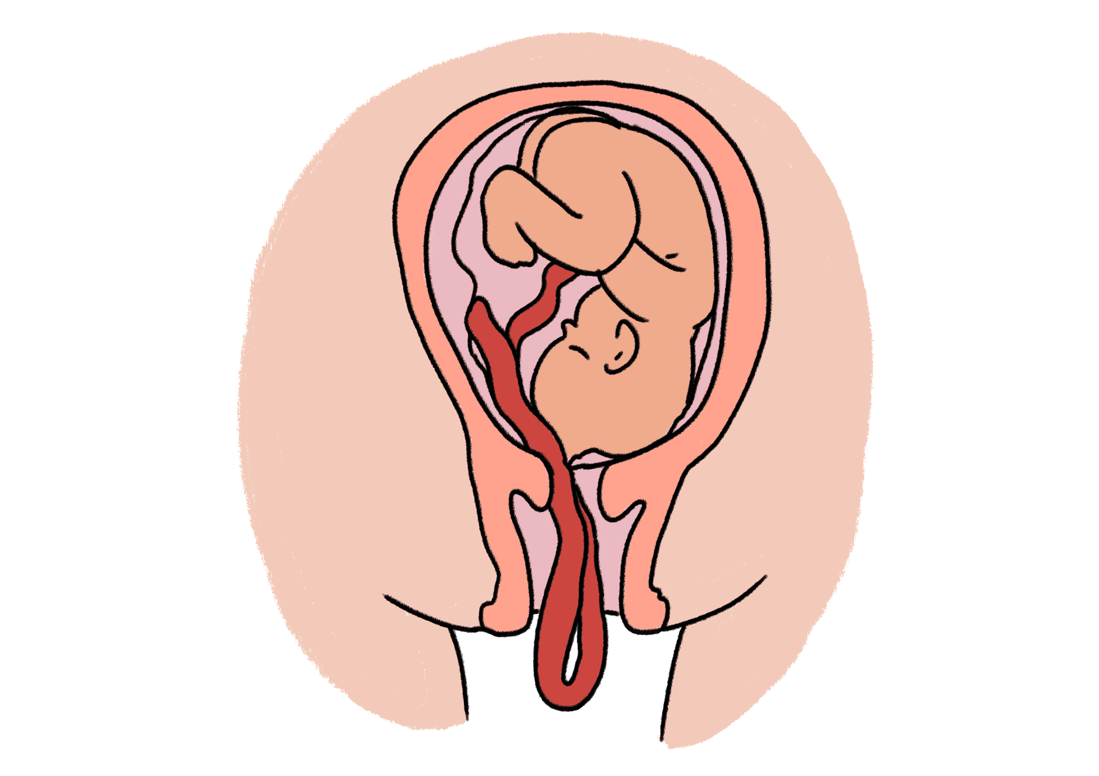 A cross-sectional illustration of a baby in the womb, it is head down and its umbilical cord has descended through the cervix ahead of the baby.