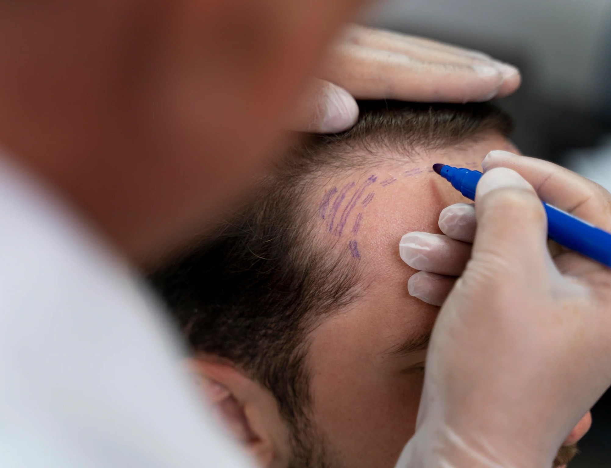 Follicular Unit Extraction (FUE) Hair Transplant