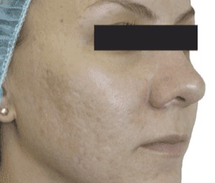 After RF microneedling - Texture & Tone