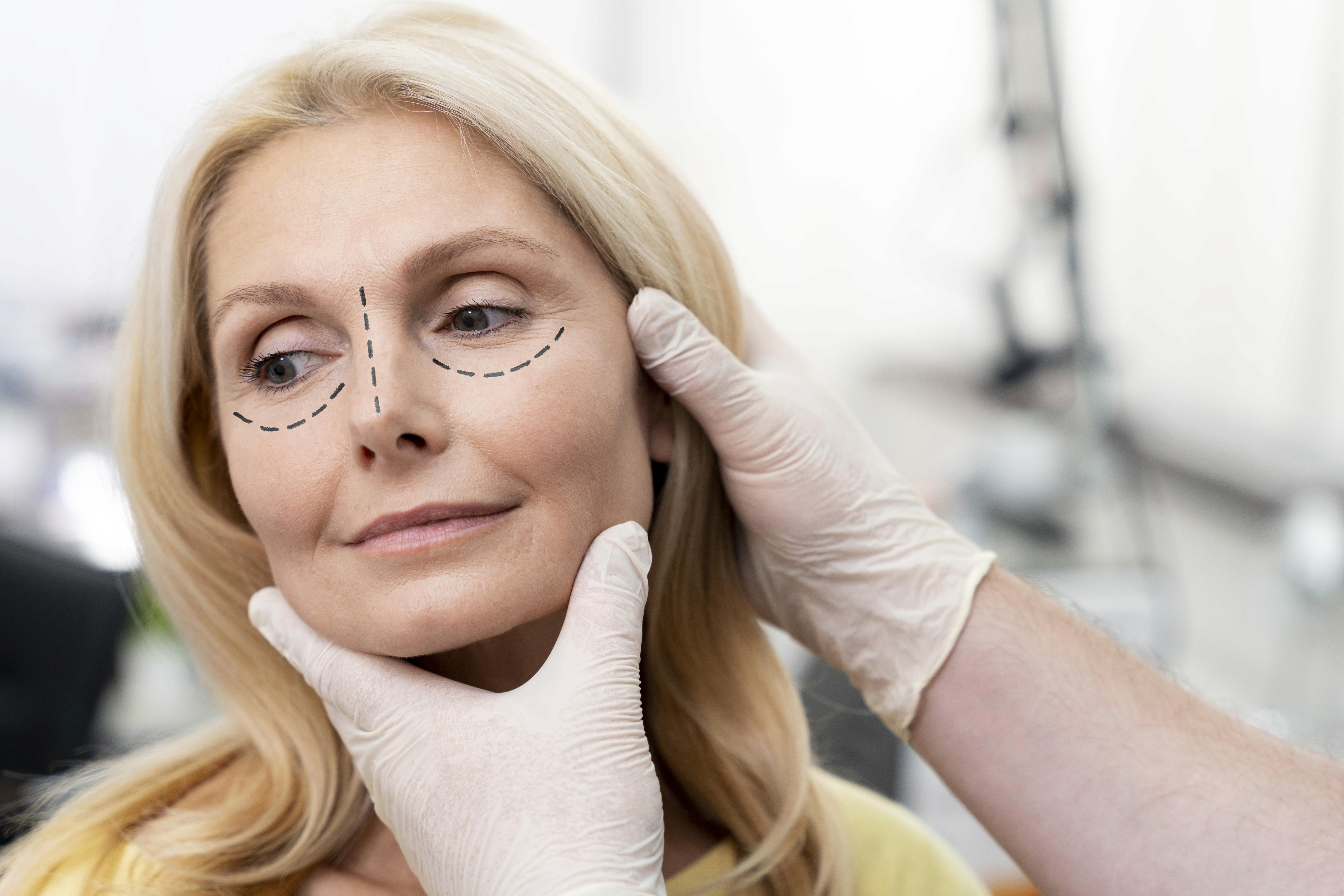 Blefaroplastia completa en Terrasa, Heaven Clinics