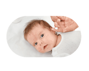 Young baby with eczema